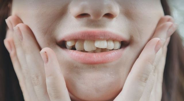 Adults Need Braces Too: Debunking the Myth That Braces Are Only for Children